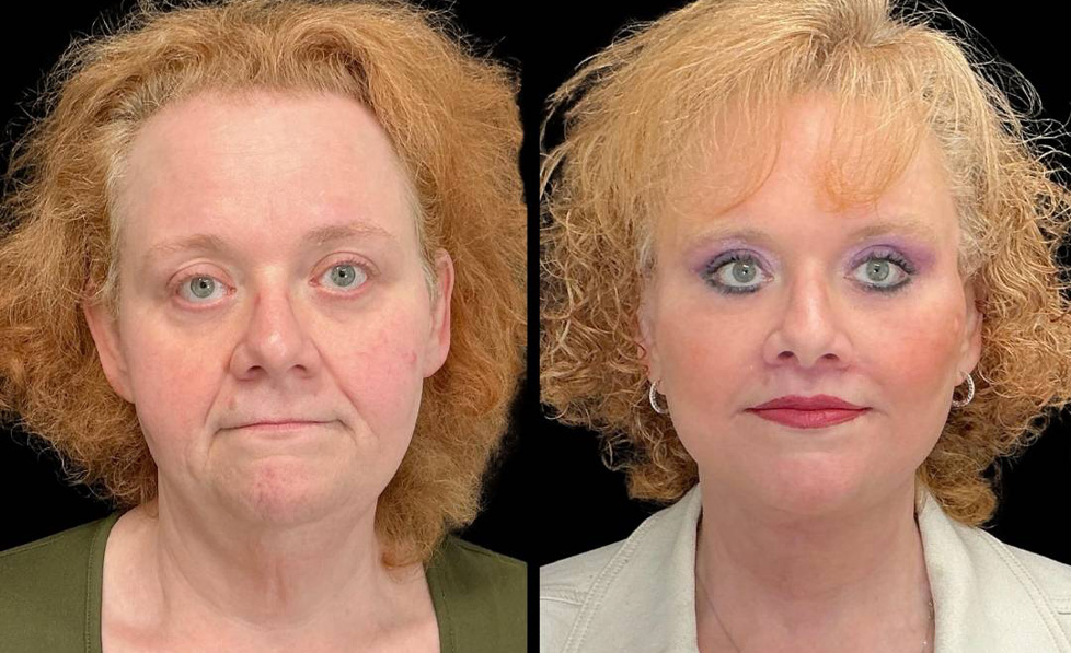 Facelift-Forehead-Lift-Upper-Lower-Eyelid-Lift-Upper-Lip-Lift-Fat-Grafting-51-yr-old-female-before-and-after-front-view.jpg