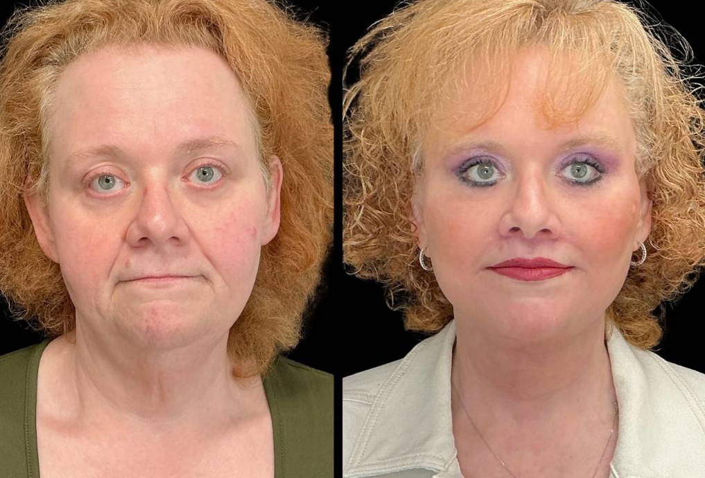 Facelift-Forehead-Lift-Upper-Lower-Eyelid-Lift-Upper-Lip-Lift-Fat-Grafting-51-yr-old-female-before-and-after-front-view.jpg