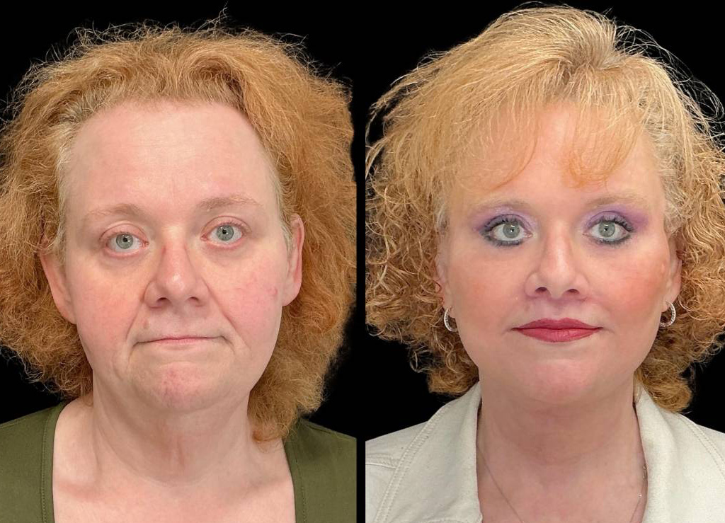 Facelift-Forehead-Lift-Upper-Lower-Eyelid-Lift-Upper-Lip-Lift-Fat-Grafting-51-yr-old-female-before-and-after-front-view.jpg