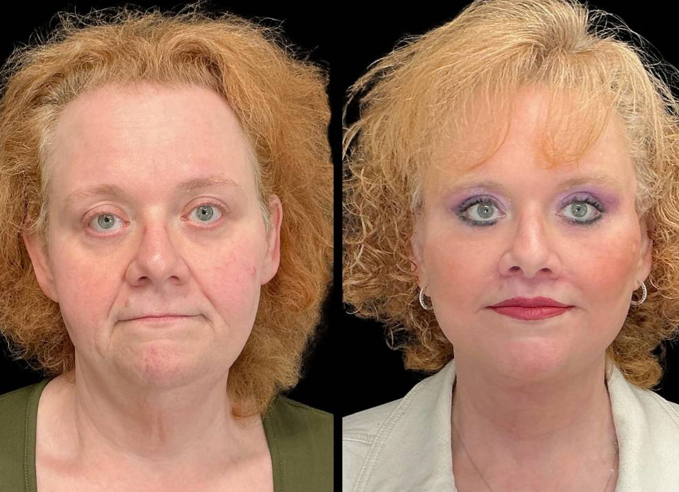 Facelift-Forehead-Lift-Upper-Lower-Eyelid-Lift-Upper-Lip-Lift-Fat-Grafting-51-yr-old-female-before-and-after-front-view.jpg