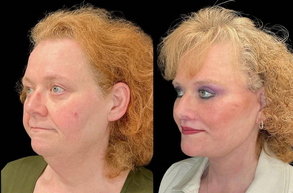 Facelift-Forehead-Lift-Upper-Lower-Eyelid-Lift-Upper-Lip-Lift-Fat-Grafting-51-yr-old-female-before-and-after-left-three-quar.jpg