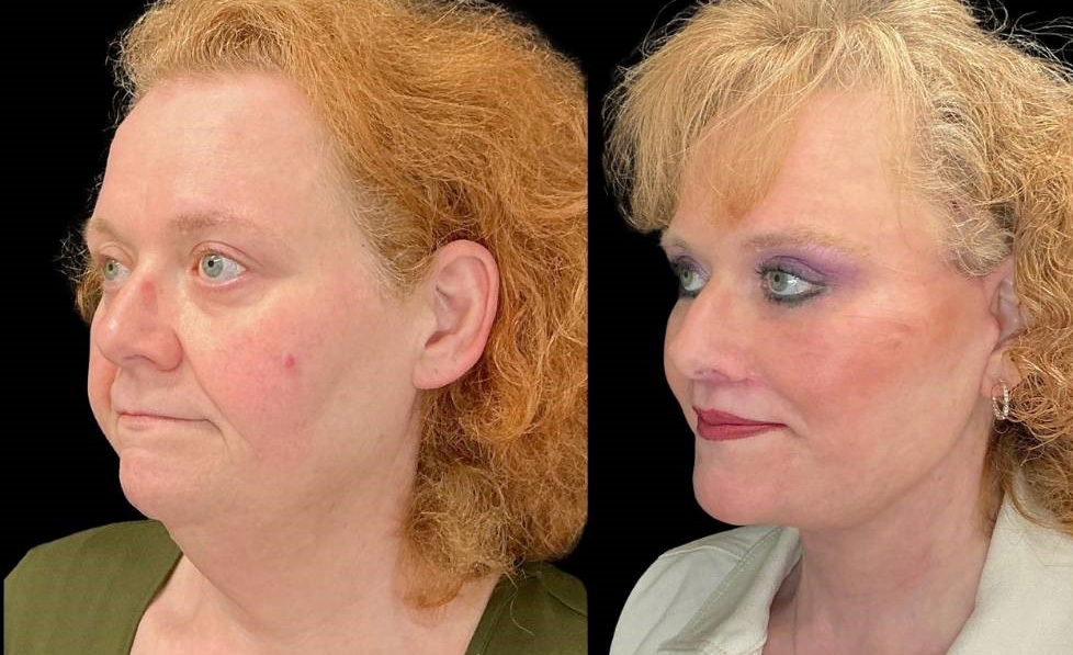 Facelift-Forehead-Lift-Upper-Lower-Eyelid-Lift-Upper-Lip-Lift-Fat-Grafting-51-yr-old-female-before-and-after-left-three-quarter-view.jpg
