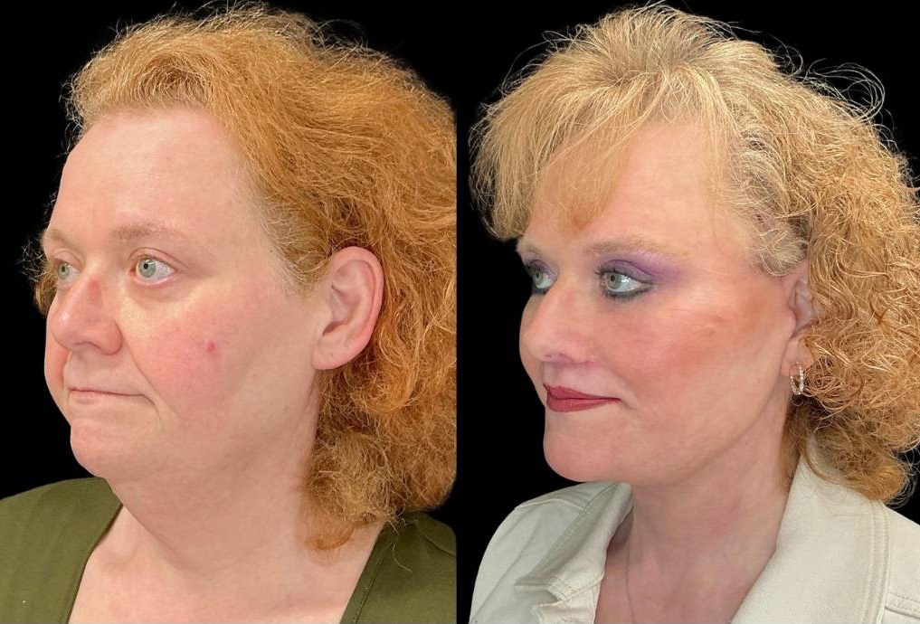 Facelift-Forehead-Lift-Upper-Lower-Eyelid-Lift-Upper-Lip-Lift-Fat-Grafting-51-yr-old-female-before-and-after-left-three-quarter-view.jpg