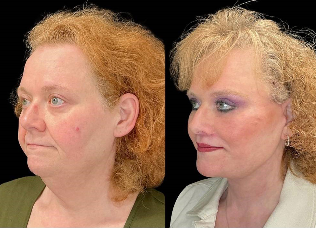 Facelift-Forehead-Lift-Upper-Lower-Eyelid-Lift-Upper-Lip-Lift-Fat-Grafting-51-yr-old-female-before-and-after-left-three-quarter-view.jpg