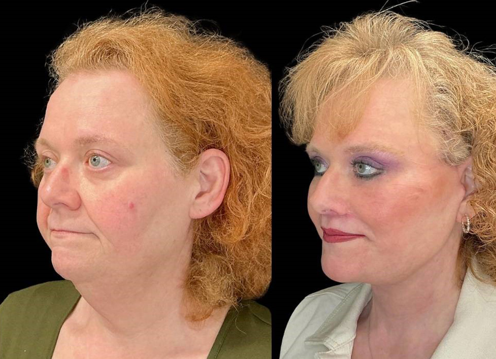 Facelift-Forehead-Lift-Upper-Lower-Eyelid-Lift-Upper-Lip-Lift-Fat-Grafting-51-yr-old-female-before-and-after-left-three-quarter-view.jpg