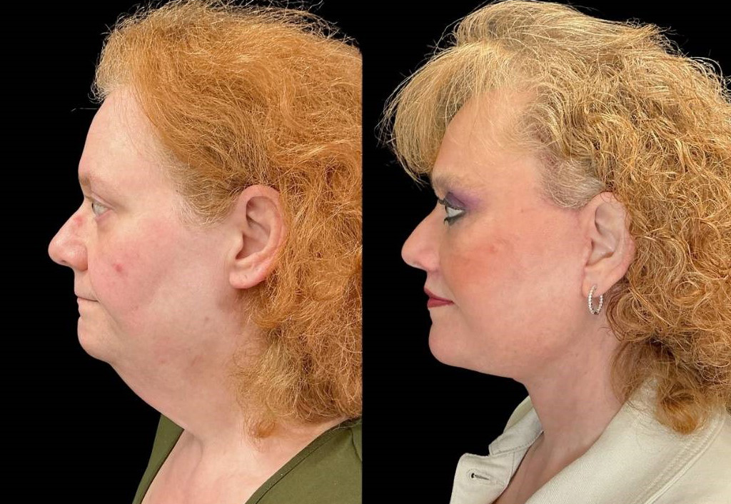 Facelift-Forehead-Lift-Upper-Lower-Eyelid-Lift-Upper-Lip-Lift-Fat-Grafting-51-yr-old-female-before-and-after-left-view.jpg