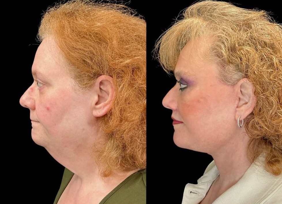 Facelift-Forehead-Lift-Upper-Lower-Eyelid-Lift-Upper-Lip-Lift-Fat-Grafting-51-yr-old-female-before-and-after-left-view.jpg