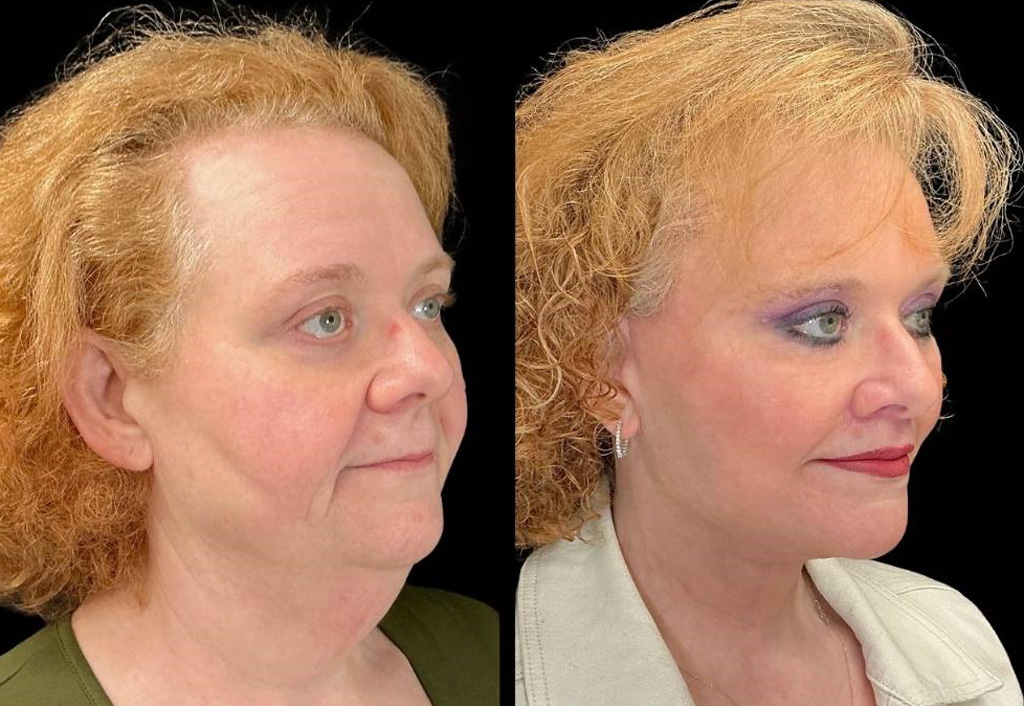 Facelift-Forehead-Lift-Upper-Lower-Eyelid-Lift-Upper-Lip-Lift-Fat-Grafting-51-yr-old-female-before-and-after-right-three-quarter-view.jpg