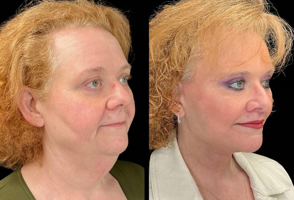 Facelift-Forehead-Lift-Upper-Lower-Eyelid-Lift-Upper-Lip-Lift-Fat-Grafting-51-yr-old-female-before-and-after-right-three-quarter-view.jpg