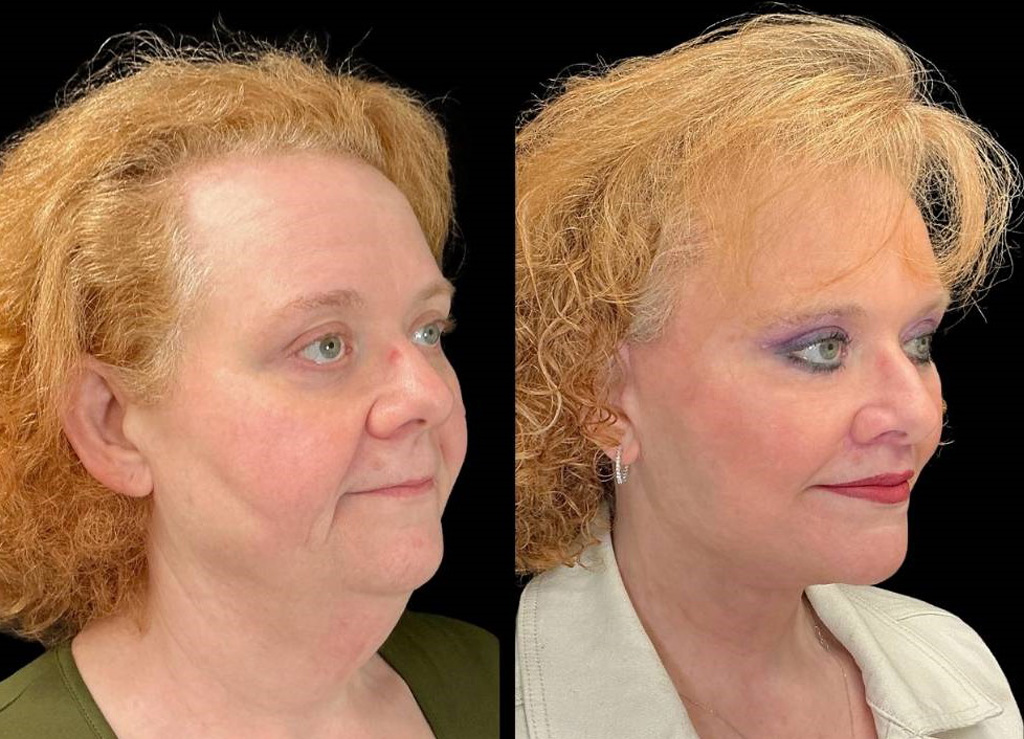 Facelift-Forehead-Lift-Upper-Lower-Eyelid-Lift-Upper-Lip-Lift-Fat-Grafting-51-yr-old-female-before-and-after-right-three-quarter-view.jpg