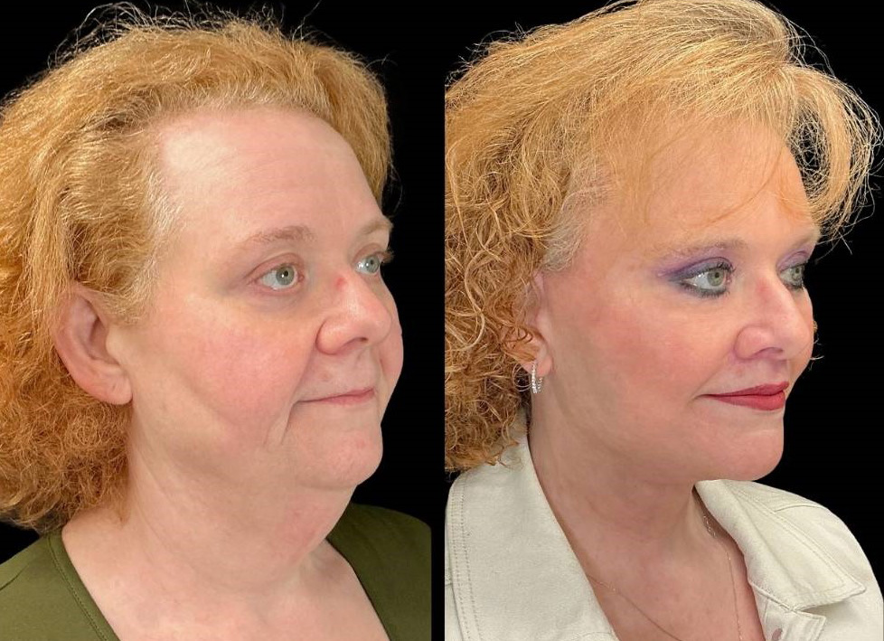 Facelift-Forehead-Lift-Upper-Lower-Eyelid-Lift-Upper-Lip-Lift-Fat-Grafting-51-yr-old-female-before-and-after-right-three-quarter-view.jpg