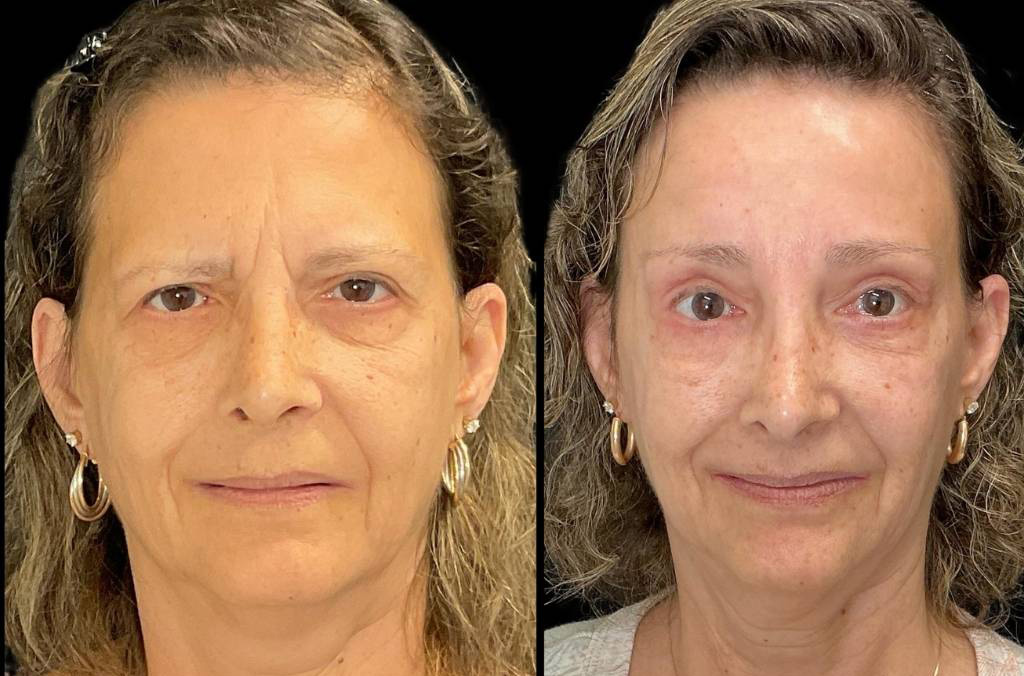 Forehead-lift-61-yr-old-female-before-and-after-front-view.jpg