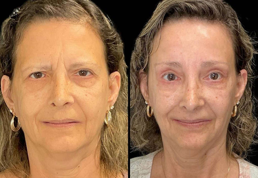 Forehead-lift-61-yr-old-female-before-and-after-front-view.jpg