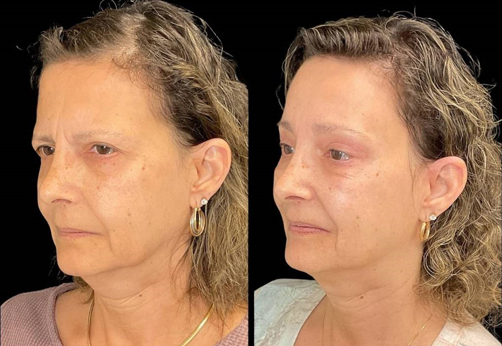 Forehead-lift-61-yr-old-female-before-and-after-left-three-quarter-view.jpg