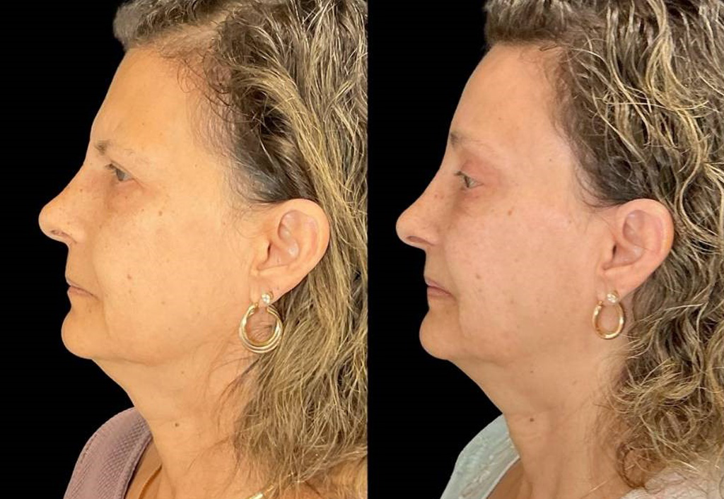 Forehead-lift-61-yr-old-female-before-and-after-left-view.jpg