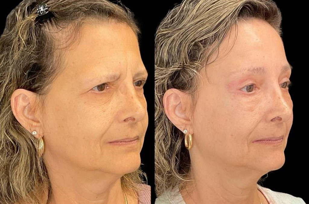 Forehead-lift-61-yr-old-female-before-and-after-right-three-quarter-view.jpg