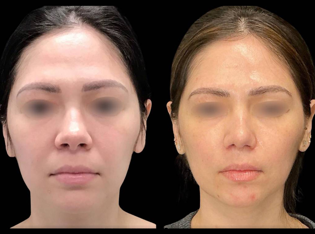Rhinoplasty-34-yr-old-female-before-and-after-front-view.jpg