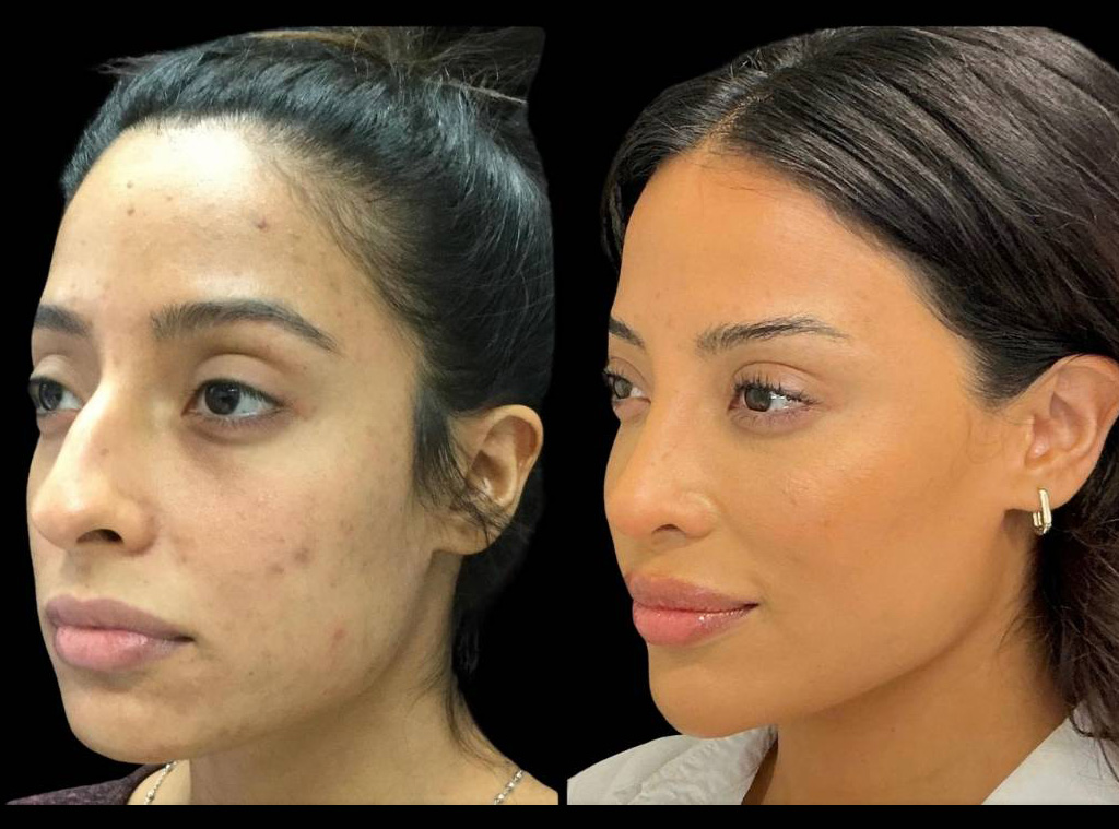 Rhinoplasty-34-yr-old-female-before-and-after-left-three-quarter-view-1.jpg