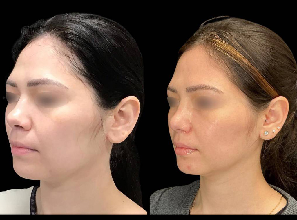 Rhinoplasty-34-yr-old-female-before-and-after-left-three-quarter-view.jpg