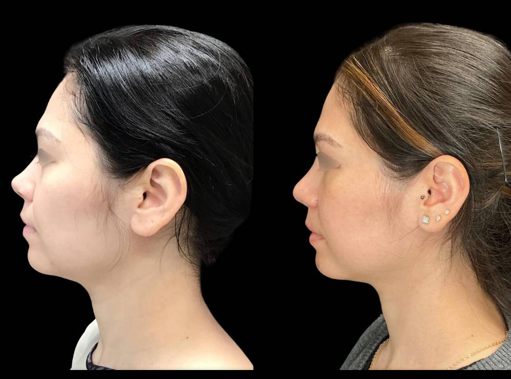 Rhinoplasty-34-yr-old-female-before-and-after-left-view-1.jpg