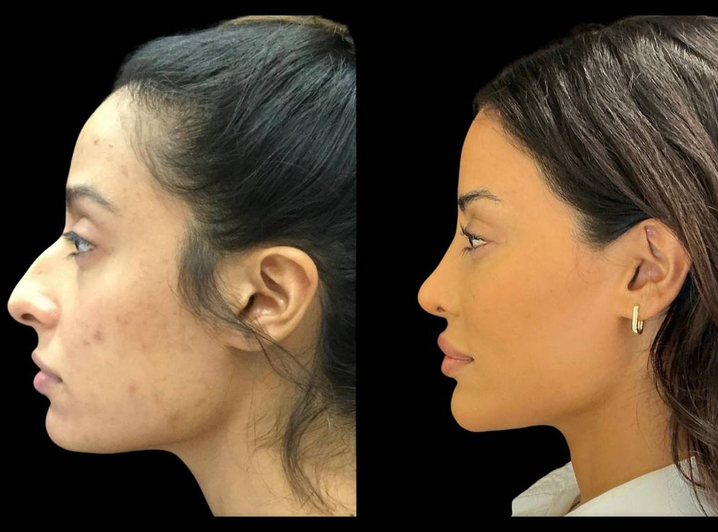 Rhinoplasty-34-yr-old-female-before-and-after-left-view.jpg