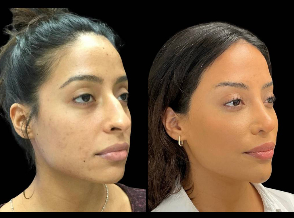 Rhinoplasty-34-yr-old-female-before-and-after-right-three-quarter-view-1.jpg