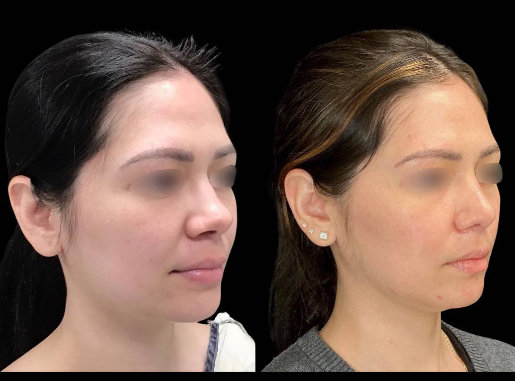 Rhinoplasty-34-yr-old-female-before-and-after-right-three-quarter-view.jpg