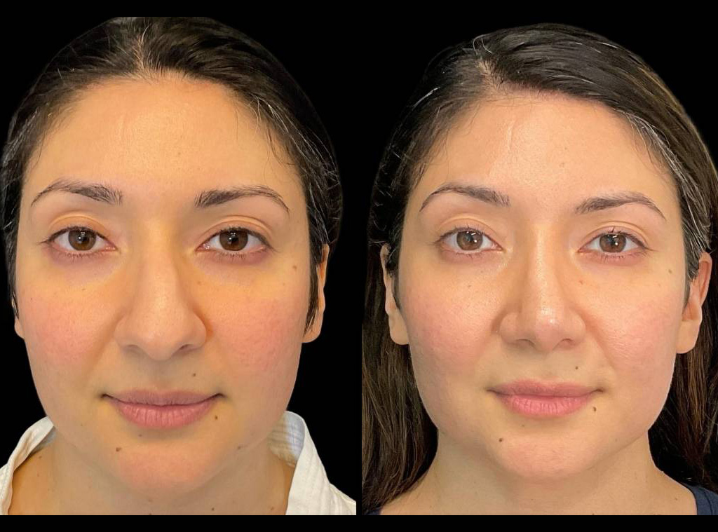 Rhinoplasty-36-yr-female-before-and-after-front-view-2.jpg