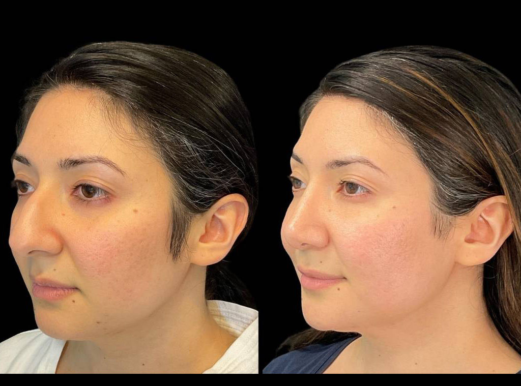 Rhinoplasty-36-yr-female-before-and-after-left-three-quarter-view-1.jpg