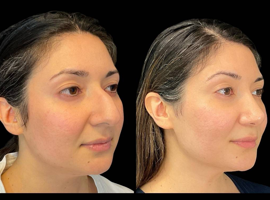 Rhinoplasty-36-yr-female-before-and-after-right-three-quarter-view-1.jpg
