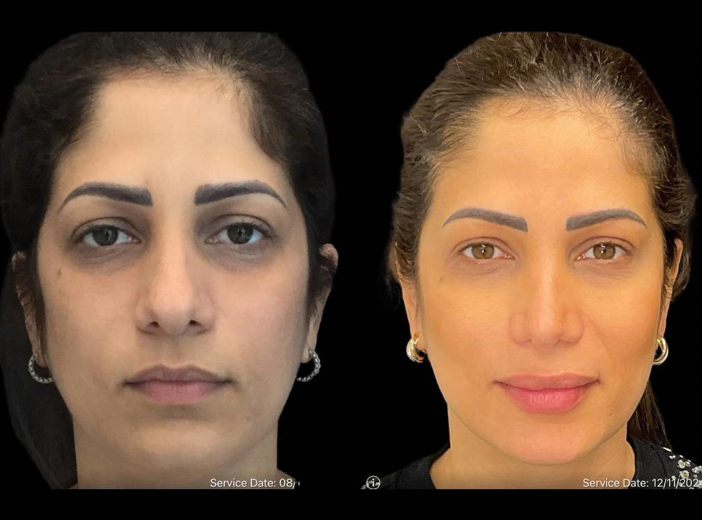Rhinoplasty-39-yr-female-before-and-after-front-view.jpg