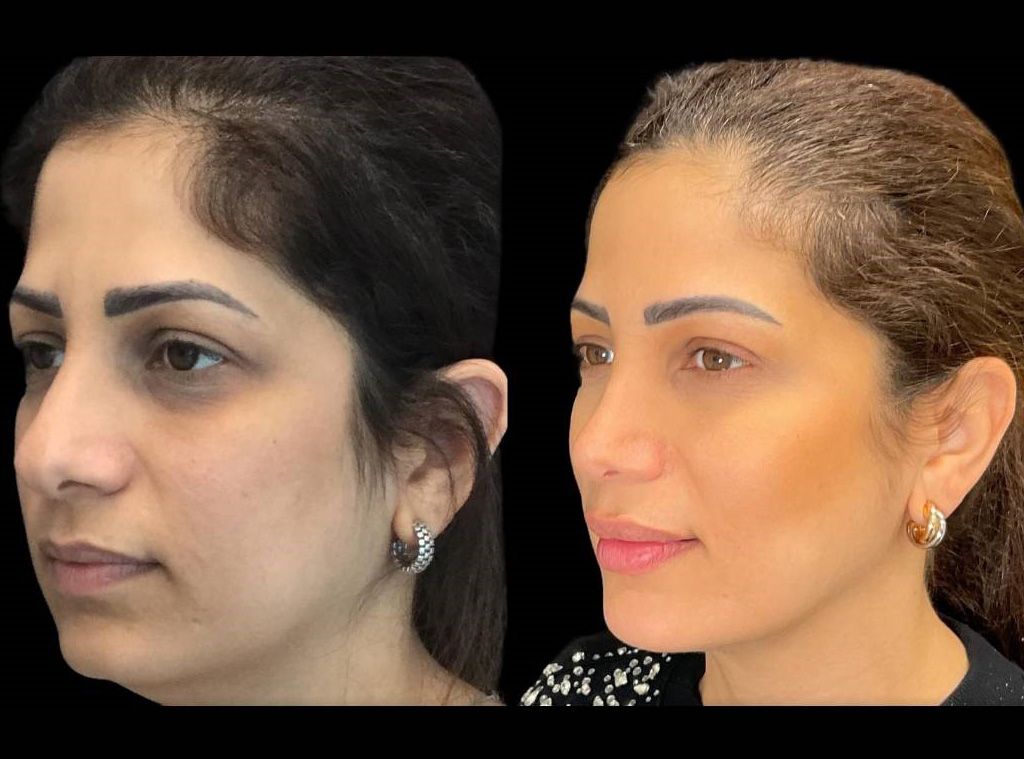 Rhinoplasty-39-yr-female-before-and-after-left-three-quarter-view.jpg
