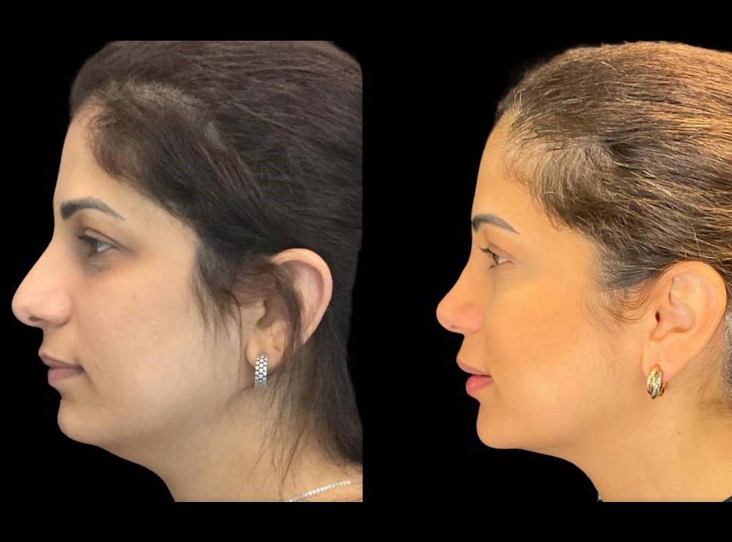Rhinoplasty-39-yr-female-before-and-after-left-view.jpg
