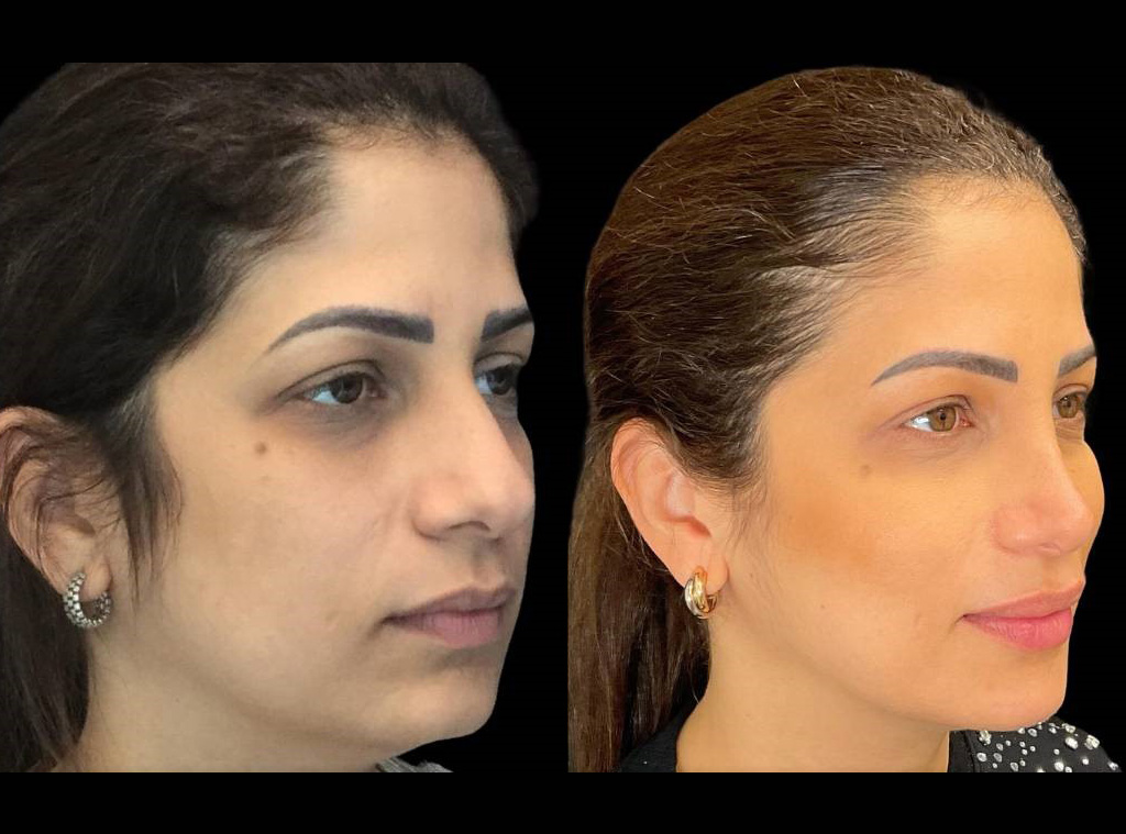 Rhinoplasty-39-yr-female-before-and-after-right-three-quarter-view.jpg