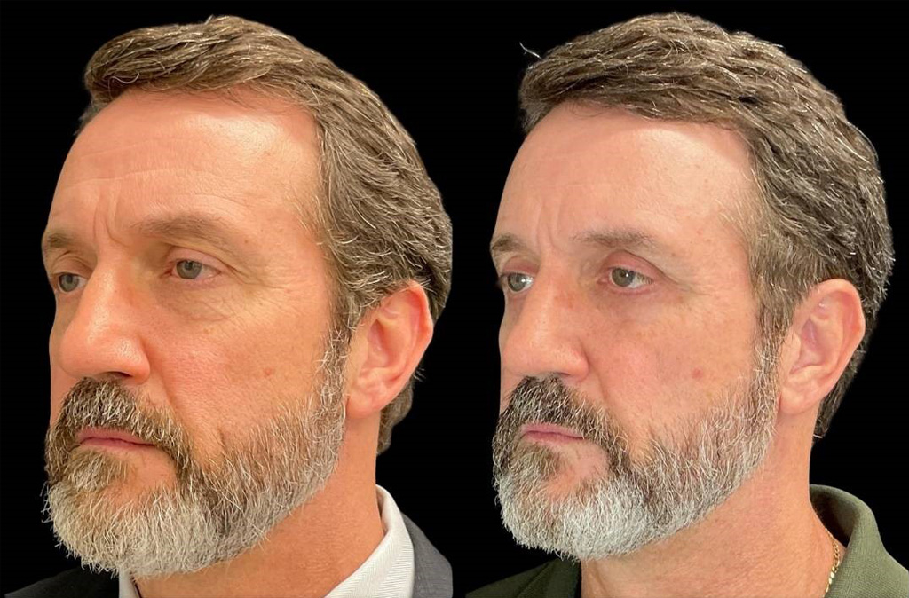 Upper-Lower-Eyelid-Lift-56-yr-old-male-before-and-after-left-three-quarter-view.jpg