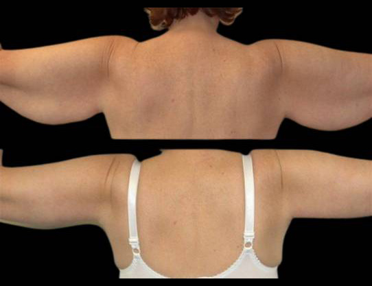 This is a female that has had an arm lift done showing the before and after's side-by-side