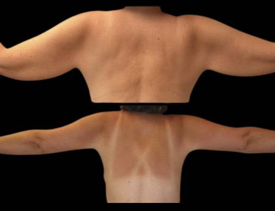 This is a female that has had an arm lift done showing the before and after's side-by-side