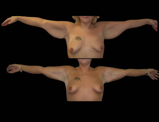 This is a female that has had an arm lift done showing the before and after's side-by-side