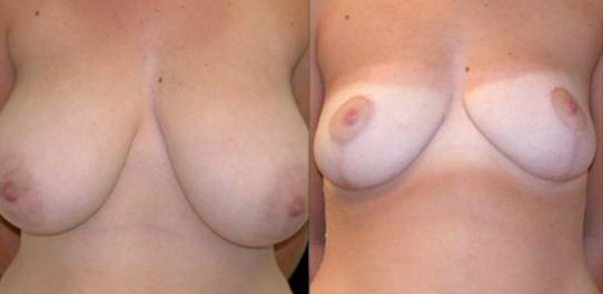 breast-reduction-before-and-after-front-view-1.jpg