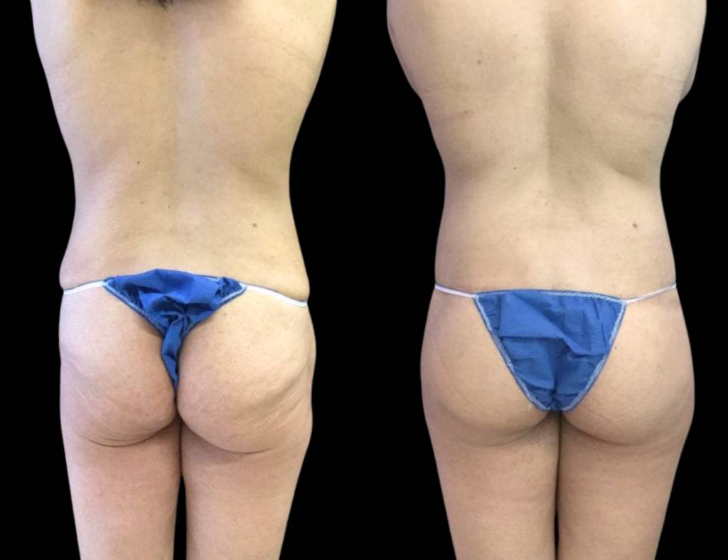 butt-lift-before-and-after-1