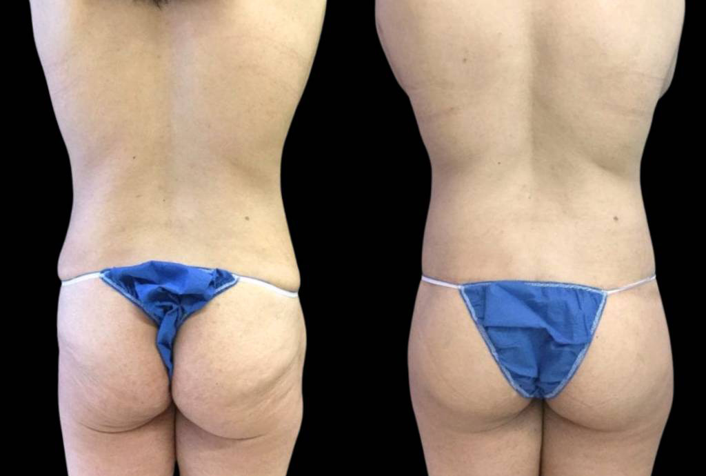 This is a female butt lift showing the before and after's side-by-side