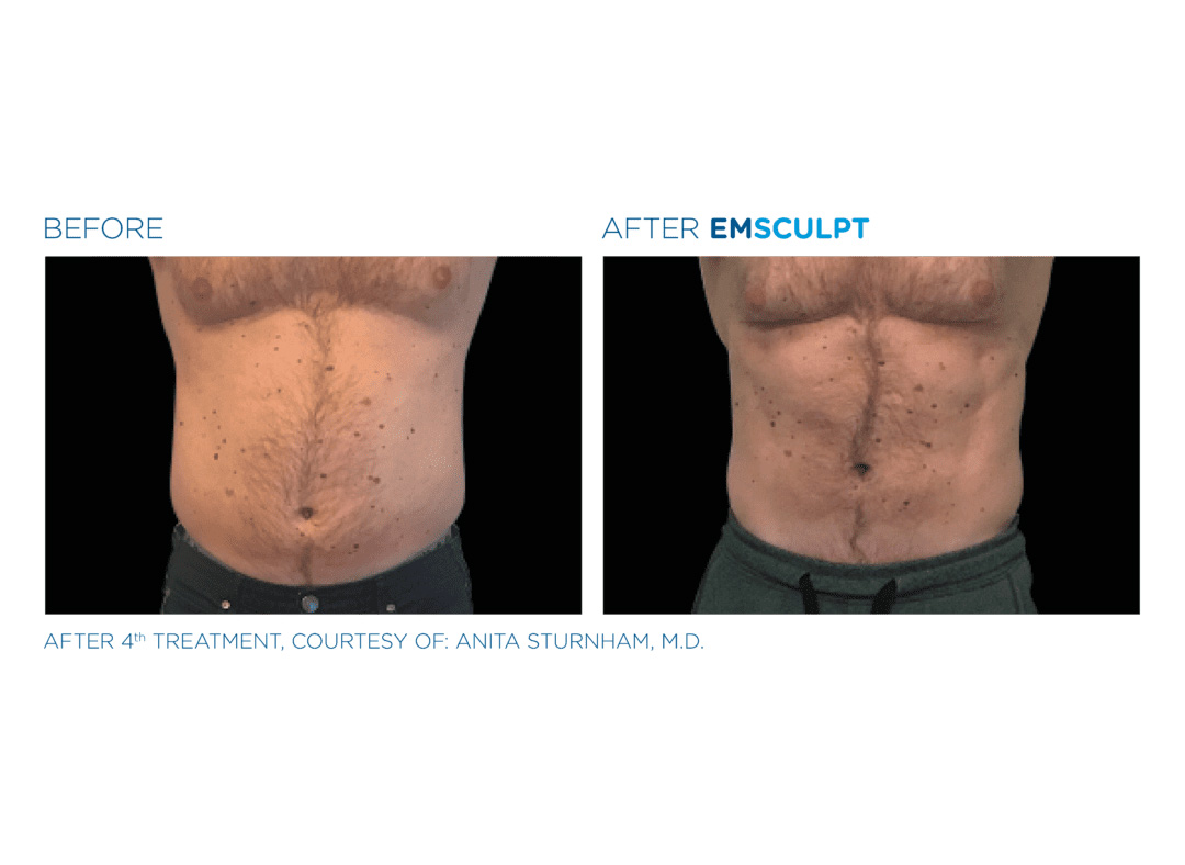 emsculpt-before-and-after-1.png