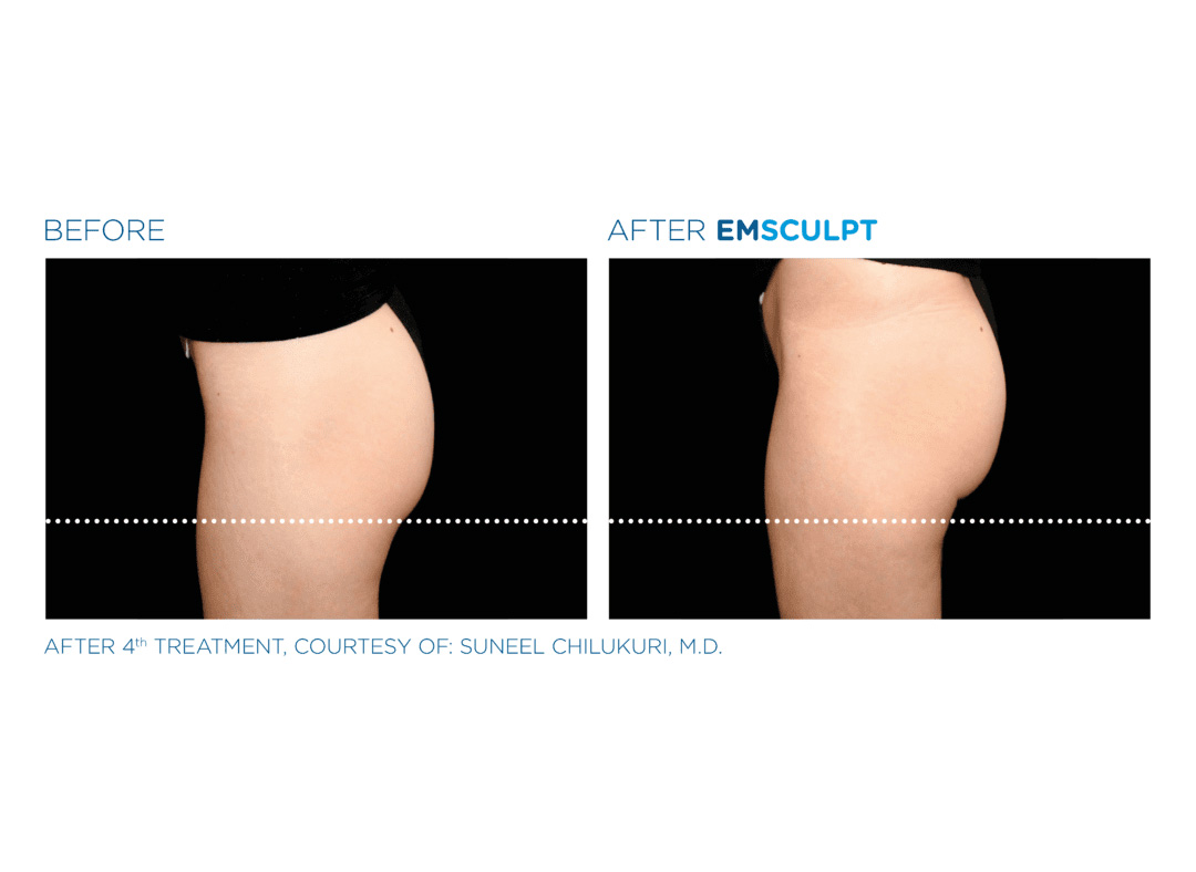 emsculpt-before-and-after-4.png