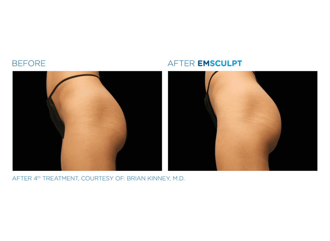 emsculpt