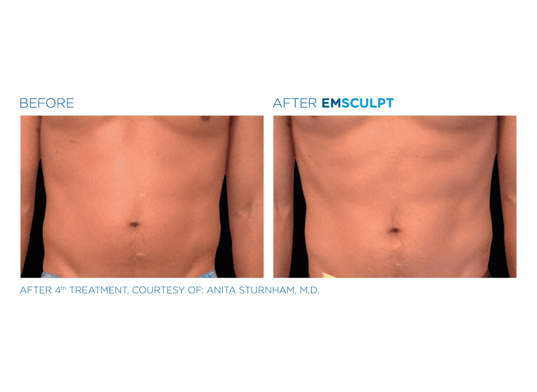 emsculpt2