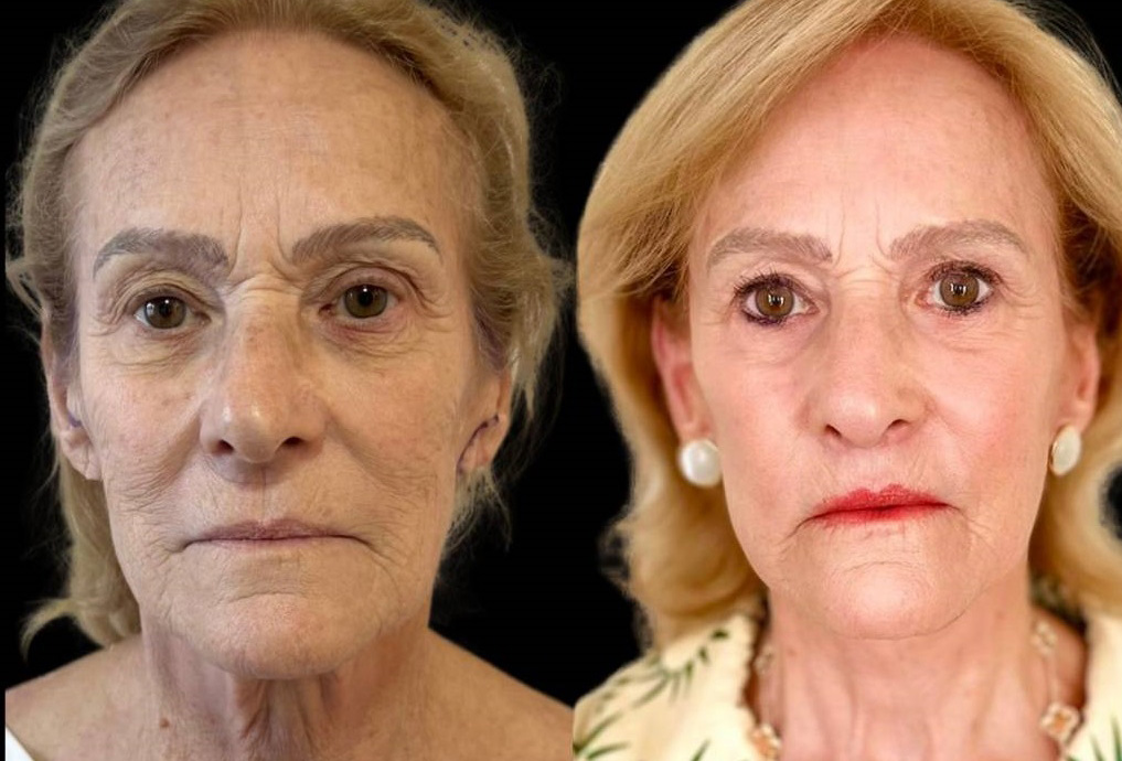 facelift-75-yr-female-before-after-front-view.jpg