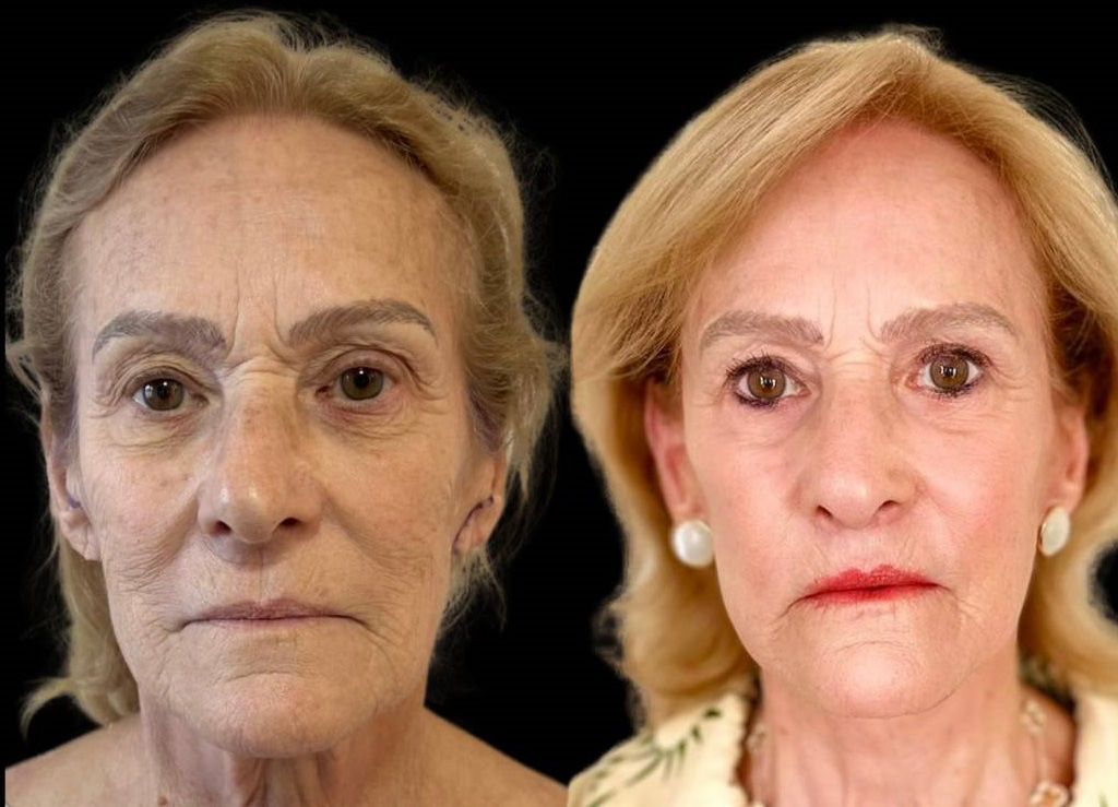 facelift-75-yr-female-before-after-front-view.jpg