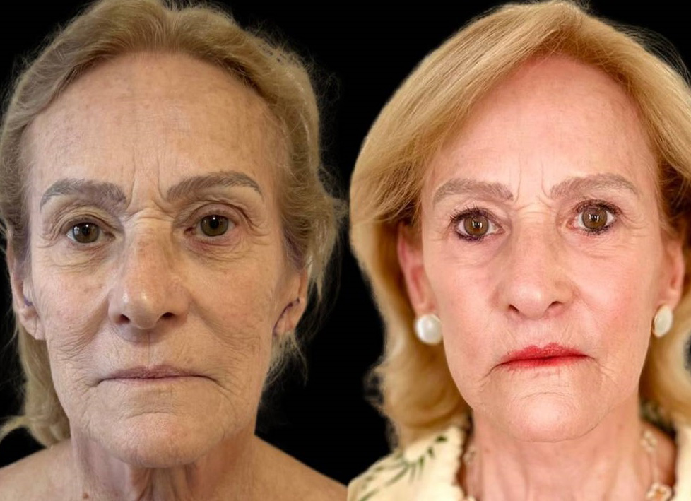 facelift-75-yr-female-before-after-front-view.jpg