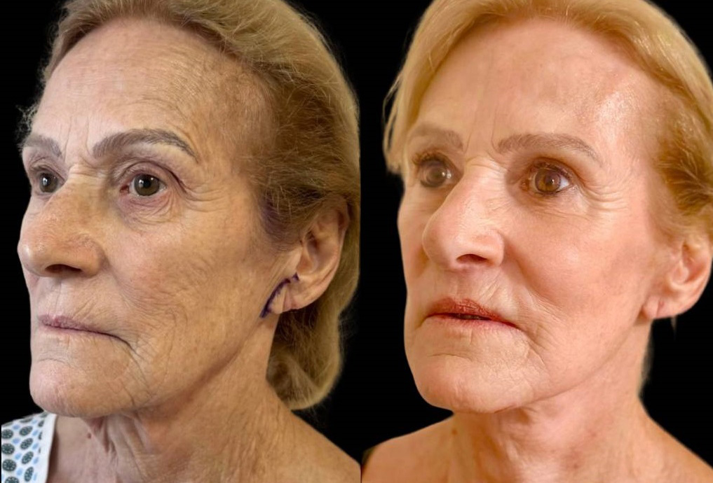 facelift-75-yr-female-before-after-left-three-quarter-view.jpg