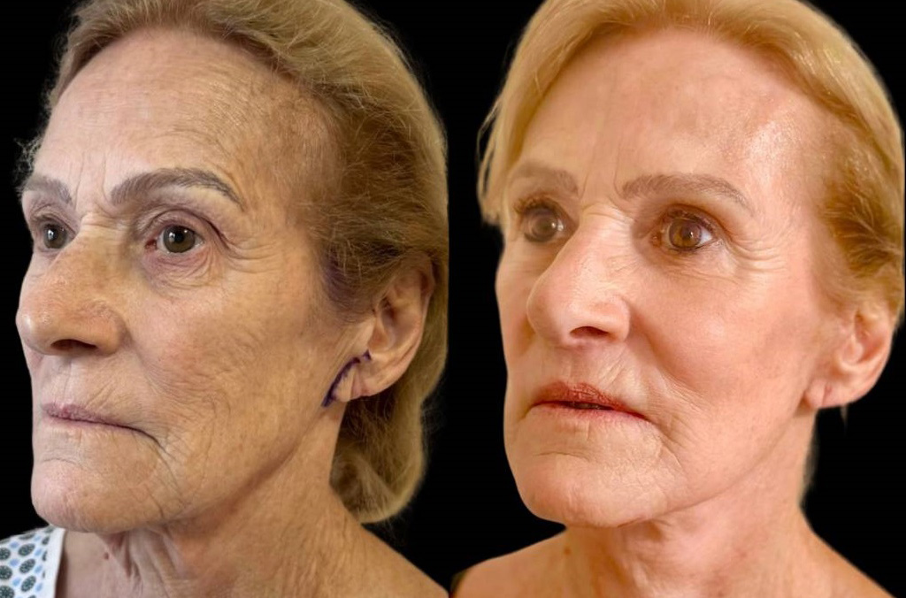 facelift-75-yr-female-before-after-left-three-quarter-view.jpg